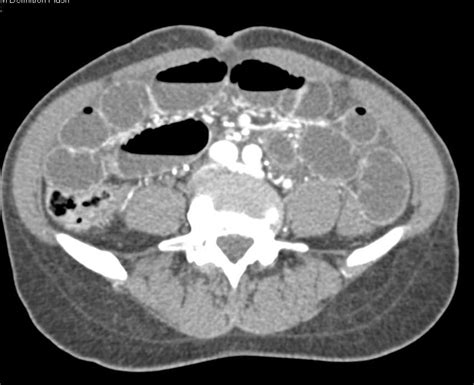 Small Bowel Obstruction Due To An Incarcerated Right Inguinal Hernia