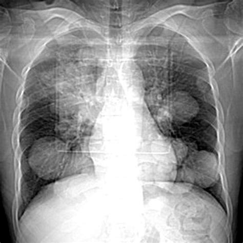 Cxr Shows Multiple Bilateral Well Defined Pulmonary Nodules And Masses Download Scientific