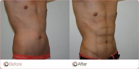 How Much Fat Can Liposuction Safely Remove Cosmos Clinic