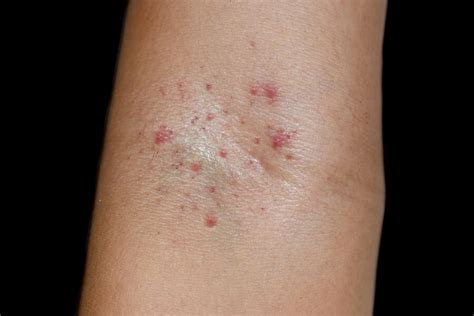 Premium Photo Group Of Small Red Spots Or Petechiae At Cubital Fossa