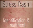 Stress Rash: Causes, Symptoms, Pictures, & Treatment | HubPages