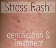 Stress Rash: Causes, Symptoms, Pictures, & Treatment - HubPages