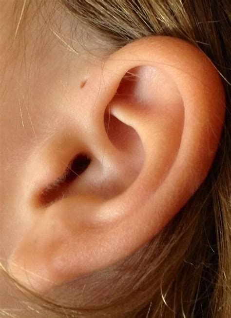 Preauricular Cyst Excision