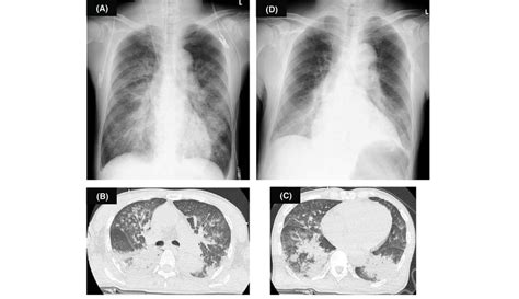 Imaging Of A 71 Year Old Man With Severe Immersion Pulmonary Edema