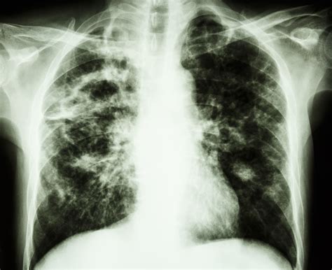 In most forms of the disease, the bacillus spreads slowly and widely in the lungs, causing the formation of hard nodules. Tuberculosis - Net Health Book