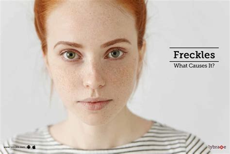Freckles What Causes It By Dr Tarun Mittal Lybrate