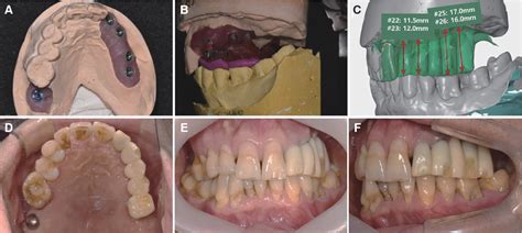 Figure 3 From Implant Assisted Removable Partial Denture Using Milled
