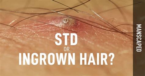 Herpes and ingrown hairs are both common and have similar symptoms, so how can people differentiate between them? Perfect Health Blog For Maximum Safety - Manscaped.com ...
