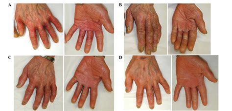Treatment Of Capecitabine‑induced Hand‑foot Syndrome Using A Topical