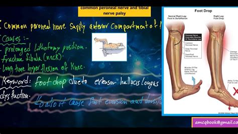 C8 Radiculopathy Common Peroneal Nerve And Tibial Nerve Palsy Notes
