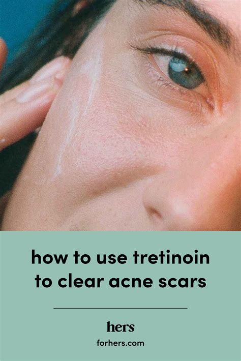 Everything You Need To Know About Hormonal Acne Artofit