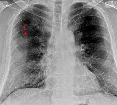 Chest Radiograph Case 34