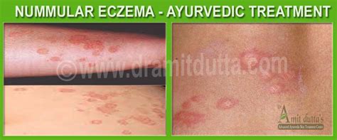 Nummular Eczema Best Ayurvedic Treatment In Punjab India