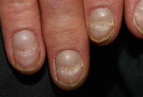 Chronic Iron Deficiency Anemia Changes Your Nails