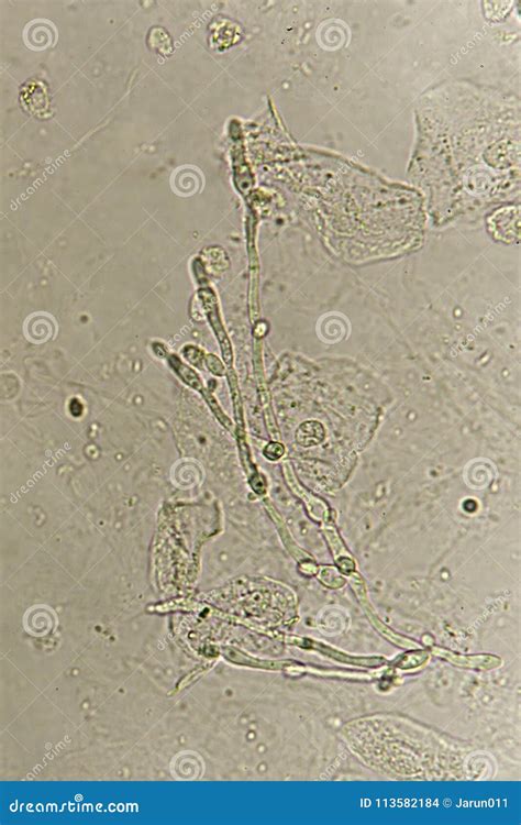 Pseudohyphae And Budding Yeast Cells In Urine Stock Photo Image Of