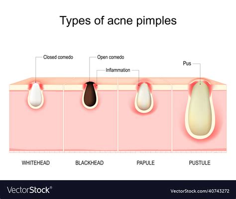 acne pustule cross section of a human skin hair follicle with pus sexiz pix