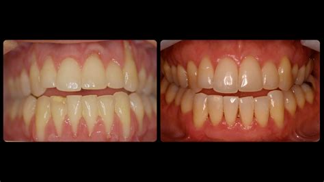 Before After Final 13 Boston Periodontist Schrott Perio Implants