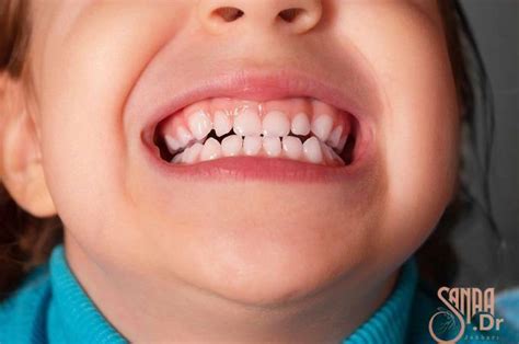 علت دندان قروچه کودکان در خواب و بیداری چیست؟