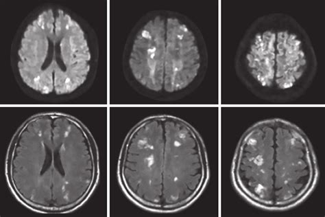 Mri Brain Of Case 1 Showing Multiple Infarcts Download Scientific Diagram