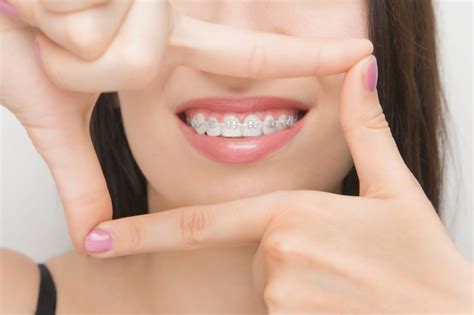 Care After Braces Faqs Answered By Expert Orthodontist In Carmel