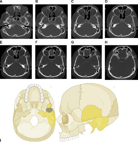 Single Skull Base Fracture Extending The Temporal Cranial Vault A