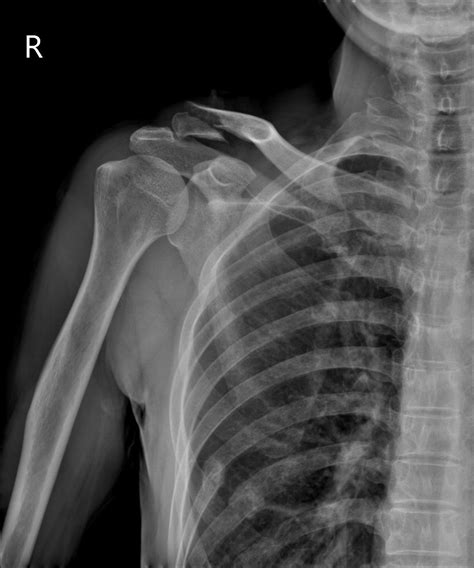 Clavicle Shaft Fractures Trauma Orthobullets