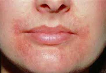 Skin tests in food allergy are not of much help. 2 Common Types of Pimples around mouth - Causes ...