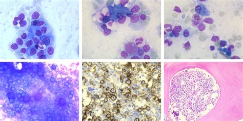 Numerous Russell Bodies And Dutcher Bodies In Multiple Myeloma Gammeren 2015 British