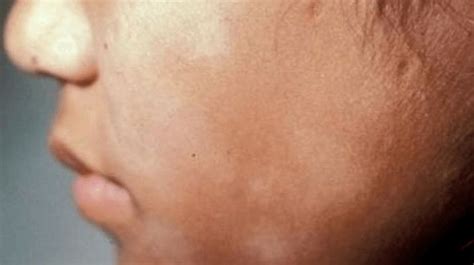 How To Get Rid White Spots On Face And Its Causes Manchas Manchas