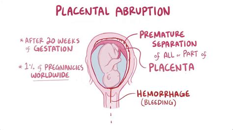 Placental Abruption Video Anatomy Definition Osmosis