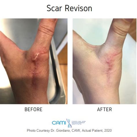 Scar Revision Before And After Pictures From Cami In Huntersville