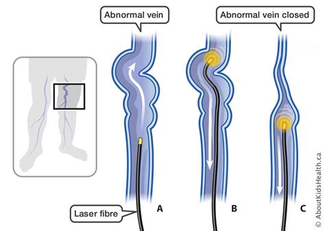 Endovenous Laser Therapy Using Image Guidance