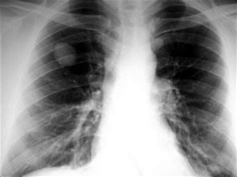 Chest X Ray Shows The Solitary Pulmonary Nodule In The Right Lung My Xxx Hot Girl