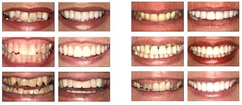 Entfernen sie rote augen, werden sie akne und falten los und weißen sie die zähne! Zahnästhetik - Zahnarztpraxis Wallisellen - Ästhetische ...