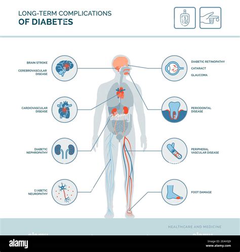 Long Term Complications Of Diabetes Medical Infographic Diabetes