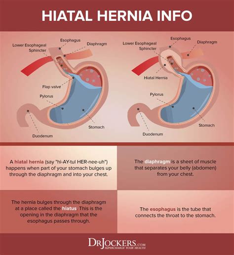 How To Know If You Have A Hiatal Hernia 10 Steps With Pictures Images