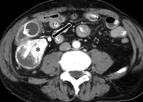 Metastasis Caused By Renal Cell Carcinoma A 71 Year Old Male Had