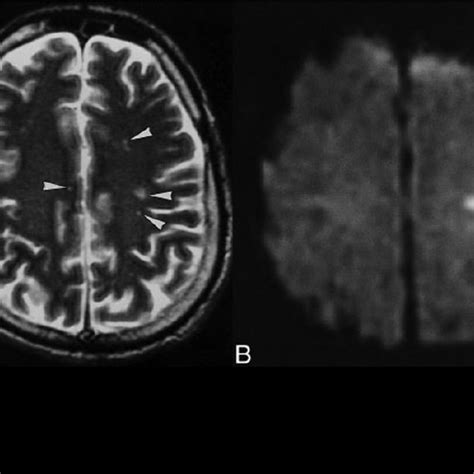 Typical Mri Pattern Of Confluent Cortical Lesions Axial Fluid