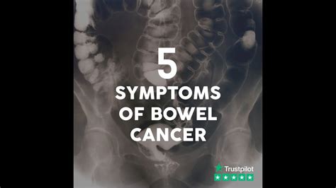 Symptoms Of Bowel Cancer Youtube