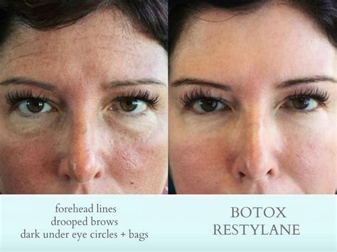 Filler Botox Dermal Fillers Botox Eyebrow Lift