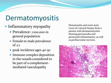 PPT Dermatomyositis PowerPoint Presentation Free Download ID