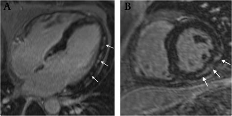 The mri myocarditis protocol encompasses a set of different mri sequences for the cardiac assessment in case of suspected myocardial inflammation. Cardiac MRI of Lyme disease myocarditis | Heart