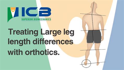 Treating Large Leg Length Differences With Orthotics Youtube