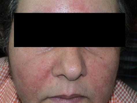 Dermatitis Ekzema Seborrheic Dermatitis Picture Hellenic