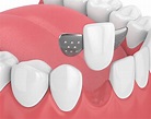What is a Dental Bridge? | Mi DENTAL