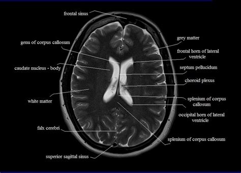 Ct Scan Brain Anatomy Anatomy Of Head Ct Scan Normal The Brain On Ct