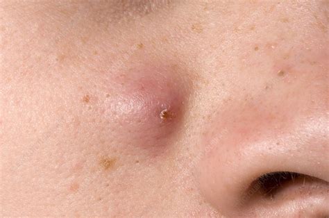 Nodular Acne Symptoms Causes And How To Treat It 41 OFF