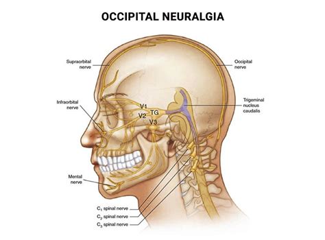 Occipital Neuralgiain Nyc Nj Advanced Headache Center