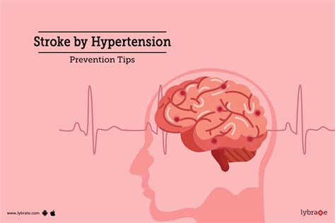 Stroke By Hypertension Prevention Tips By Dr Garima Lybrate