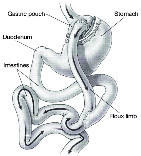 Schema Of Laparoscopic Roux En Y Gastric Bypass A Small Proximal